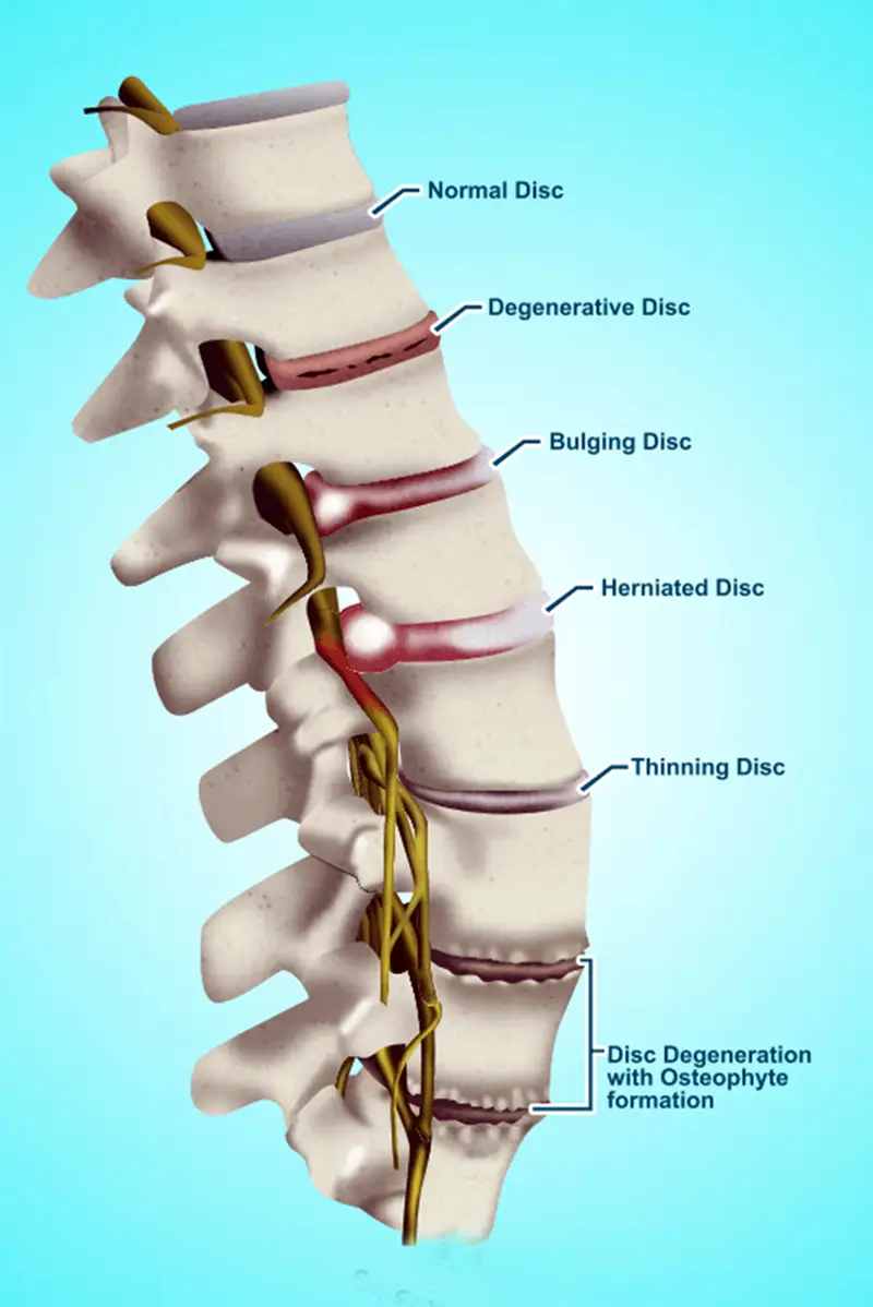 Non-Surgical Spinal Decompression decompressionconditions