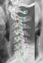 figure 1. lateral cervical radiographs. left initial (2 26 18) showing cervical kyphosis from c2 c6 figure 1. lateral cervical radiographs. left initial (2 26 18) showing cervical kyphosis from c2 c6