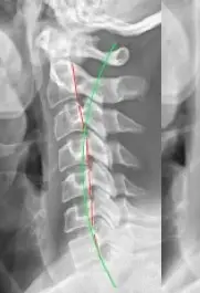 Digital X-Ray & PostureRay Reports Digital X-ray analysis of the cervical spine
