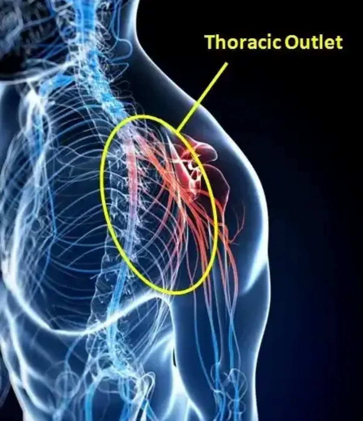 Thoracic Outlet Syndrome: A Sarasota Quarterback’s Story Thoracic Outlet Syndrome: A Sarasota Quarterback’s Story